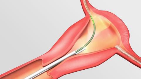 FDA-Mandated Essure Study Fails to Get Off the Ground