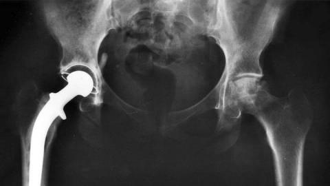 The Trouble with Stryker Hip Implants